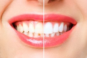 die Zähne vor und nach der Behandlung